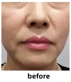 Vリフティング埋線 BEFORE