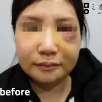 浮腫み解消 BEFORE