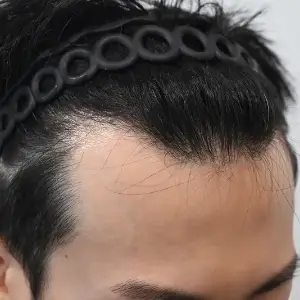 男性非切開（ヒドゥンカット）3,500株 BEFORE