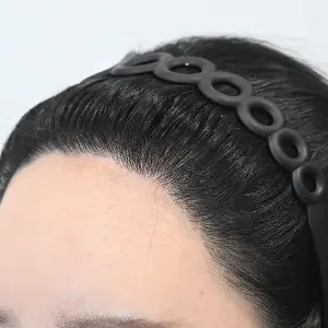 女性非切開（ヒドゥンカット）2,800株 AFTER