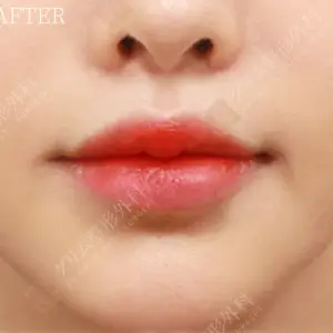 鼻下切開人中短縮＋Cカール＋小鼻縮小 AFTER