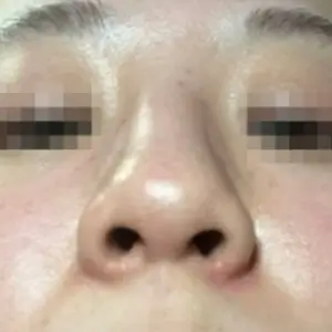 鼻整形 BEFORE
