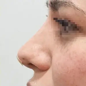 鼻フィラー（ベロテロ） AFTER