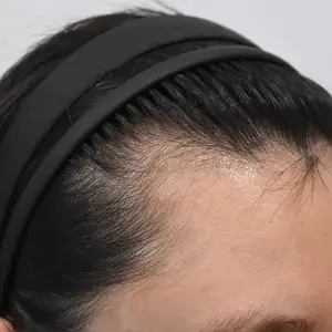 女性非切開（ヒドゥンカット）2,200株 BEFORE