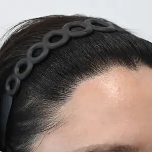 女性非切開（ヒドゥンカット）2,200株 AFTER