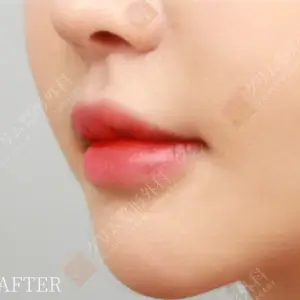 鼻下切開人中短縮＋Cカール＋小鼻縮小 AFTER