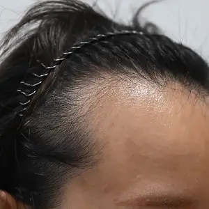 女性非切開（ヒドゥンカット）3,300株 BEFORE