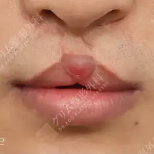 口唇口蓋裂手術 BEFORE