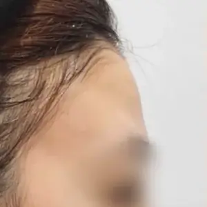 眉間フィラー（リジュビエル） BEFORE