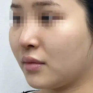 シュリンク BEFORE