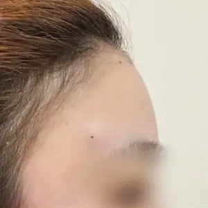 眉間フィラー（リジュビエル） AFTER