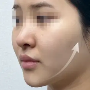 シュリンク AFTER