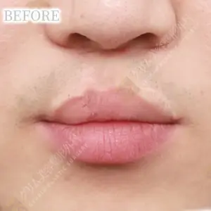 口唇口蓋裂手術 BEFORE