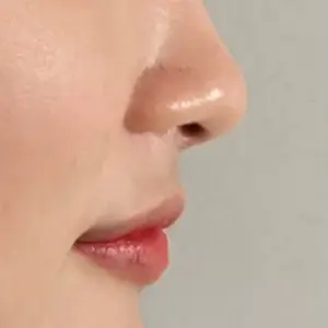 唇フィラー BEFORE