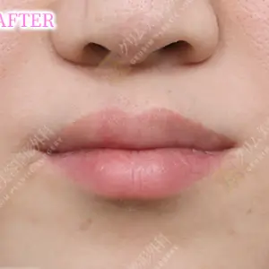 口唇口蓋裂手術 AFTER