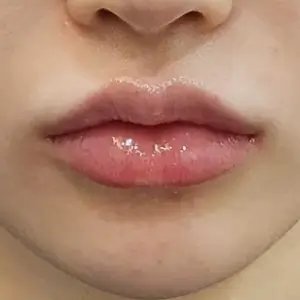 唇フィラー（レスチレン） AFTER