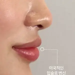 唇フィラー AFTER