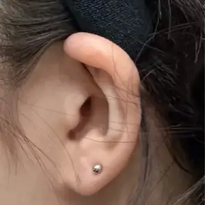 耳フィラー BEFORE