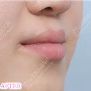 口唇口蓋裂手術 AFTER