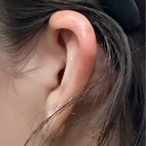 耳フィラー AFTER