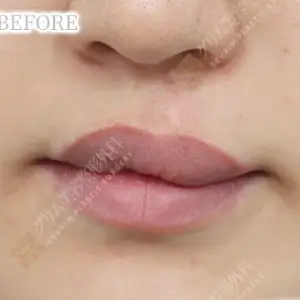 口唇口蓋裂手術 BEFORE