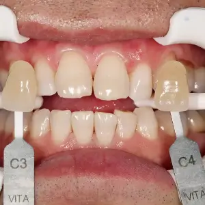 ホワイトニング AFTER