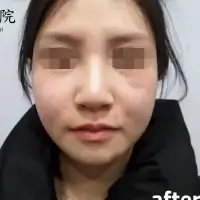 浮腫み解消 AFTER