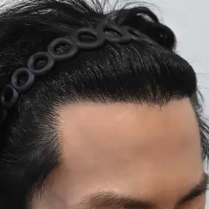 男性非切開（ヒドゥンカット）3,500株 AFTER