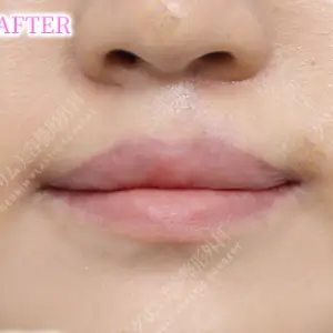 口唇口蓋裂手術 AFTER