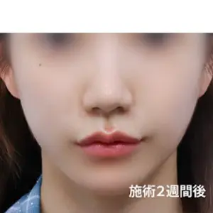 チューンフェイス+チタニウムリフト AFTER