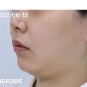ウルセラ BEFORE