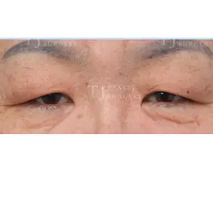 眉下リフト＋目頭上切開＋非切開一重目つき矯正 BEFORE