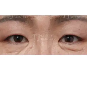 眉下リフト＋目頭上切開＋非切開一重目つき矯正 AFTER