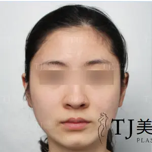 輪郭整形 BEFORE