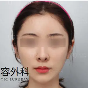 輪郭整形 AFTER