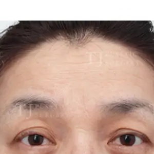 額リフト BEFORE