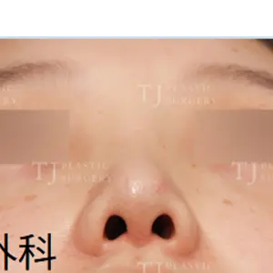 鼻整形 AFTER