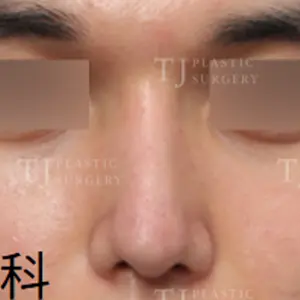 鼻整形 AFTER