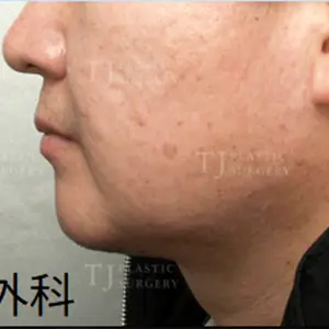 二重あご脂肪吸引 AFTER