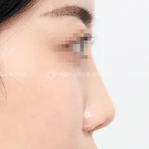 鼻整形 BEFORE