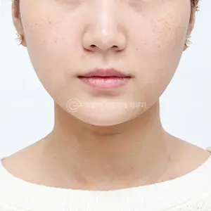 ピコトーニング BEFORE