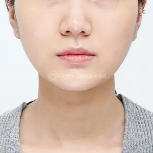 ピコトーニング AFTER