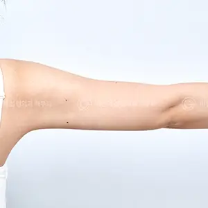 脂肪分解注射 AFTER