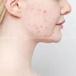 ポテンツァ+リジュラン BEFORE