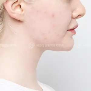 ポテンツァ+リジュラン AFTER