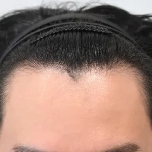 男性非切開（ヒドゥンカット）2000毛前後 BEFORE