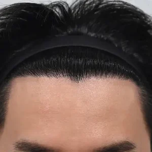 男性非切開（ヒドゥンカット）2000毛前後 AFTER