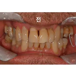 インプラント BEFORE