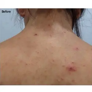 ミオルFCR　ニキビ治療 BEFORE