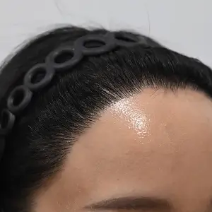 女性非切開（ヒドゥンカット）3,300株 AFTER